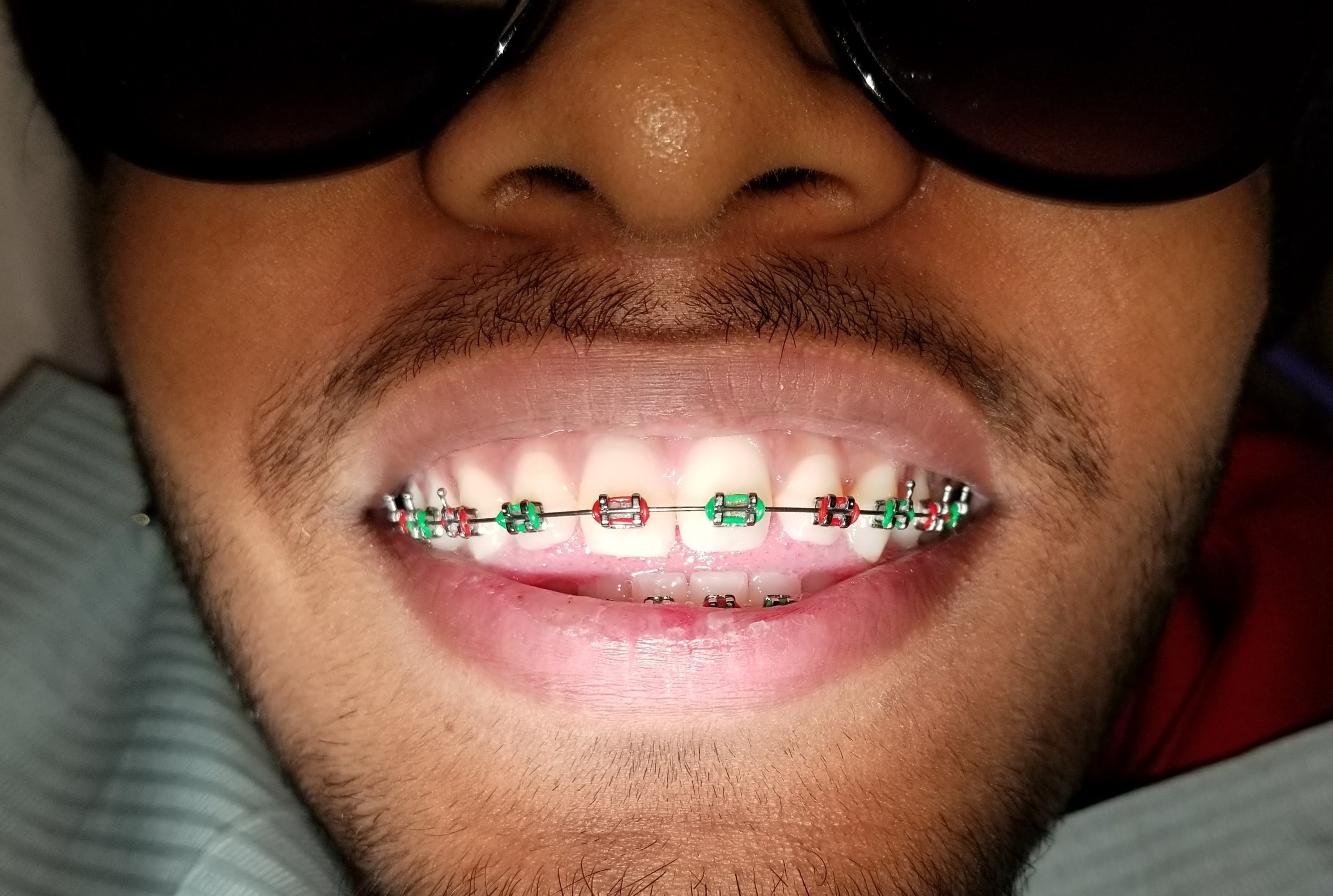 xmas-braces