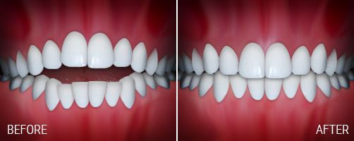 open-bite