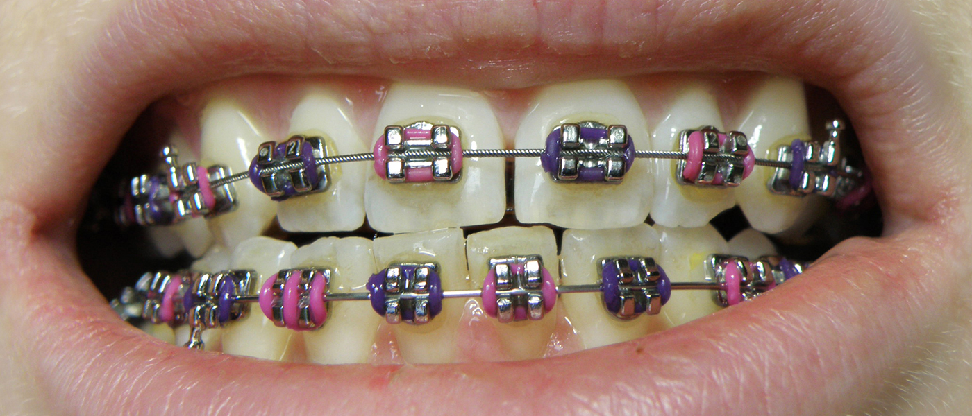 braces