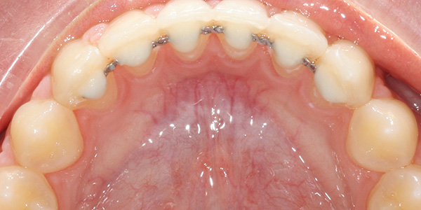 lingual-retainer-after-braces