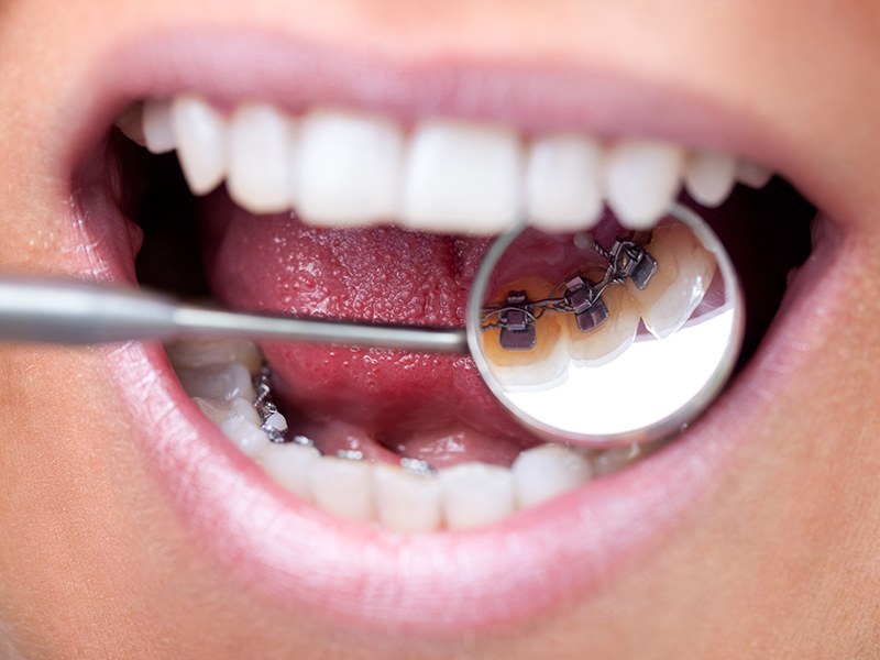 braces-on-back-of-teeth