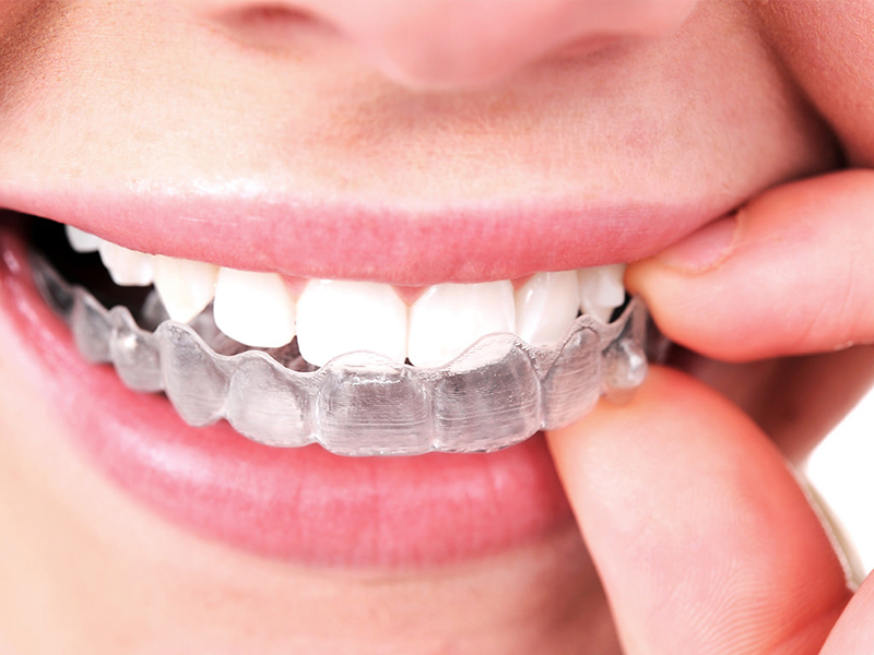 clear-aligner-invisalign
