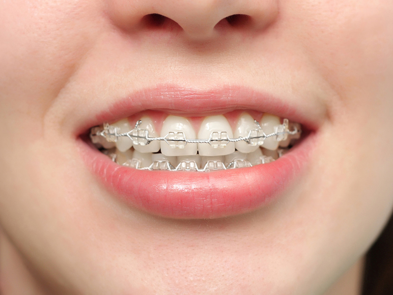 clear-bracket-braces