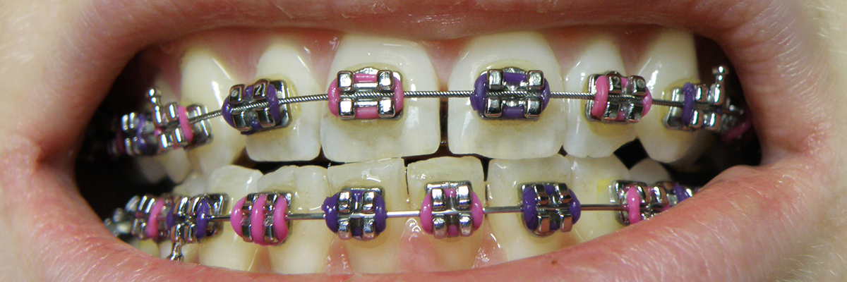 metal-braces-traditional