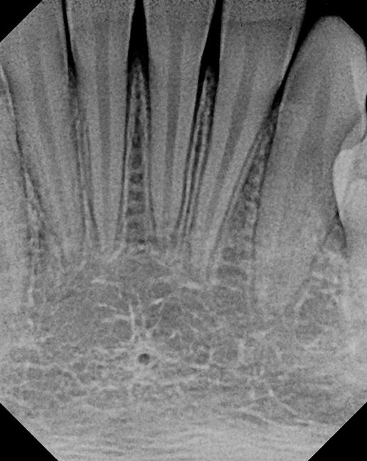 anterior-periapical-xray