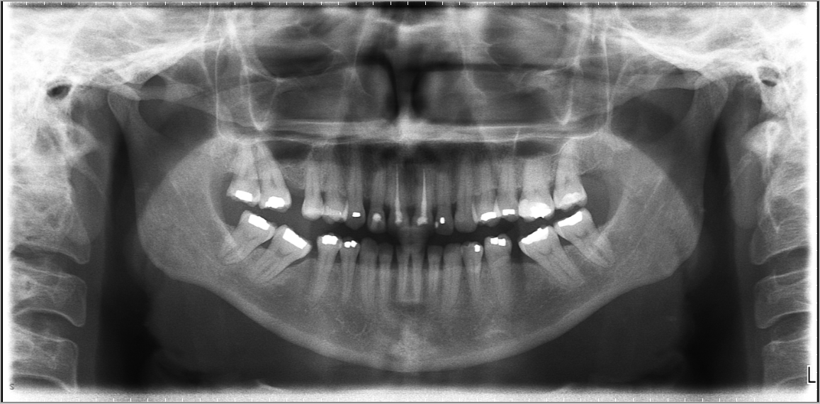 panoramic-radiograph-opg